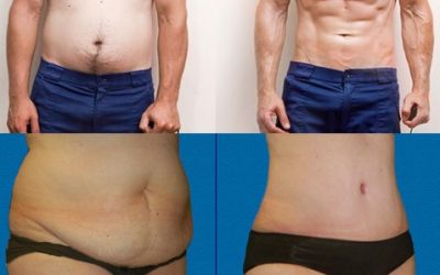 Cómo perder grasa del abdomen de forma localizada