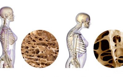 Entrenamiento Personal y ejercicios para controlar la osteoporosis