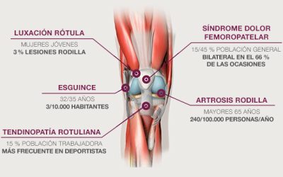 ¿Cómo prevenir y readaptar lesiones de rodilla?
